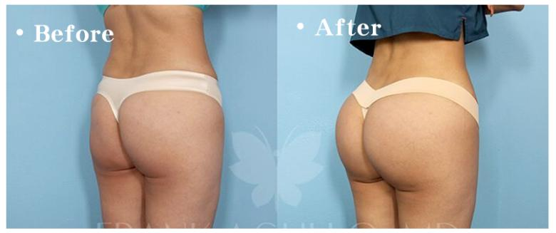 垫下巴假体费用