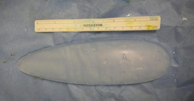 垫下巴假体费用