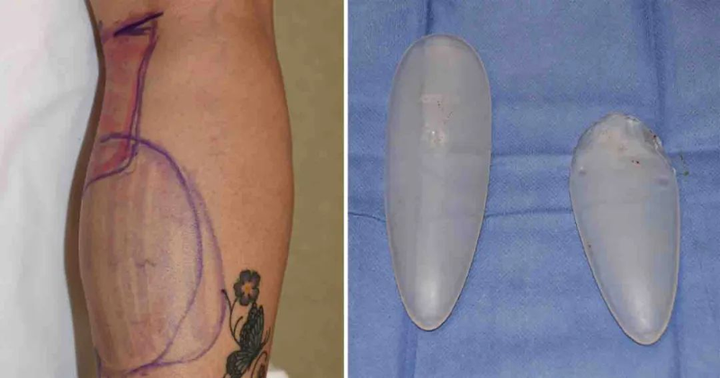 垫下巴假体费用