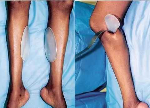 垫下巴假体费用