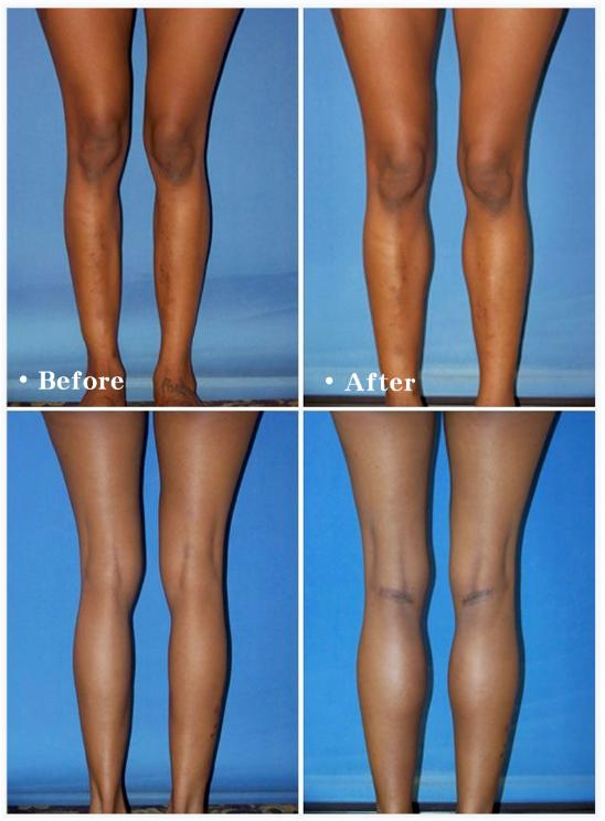 垫下巴假体费用