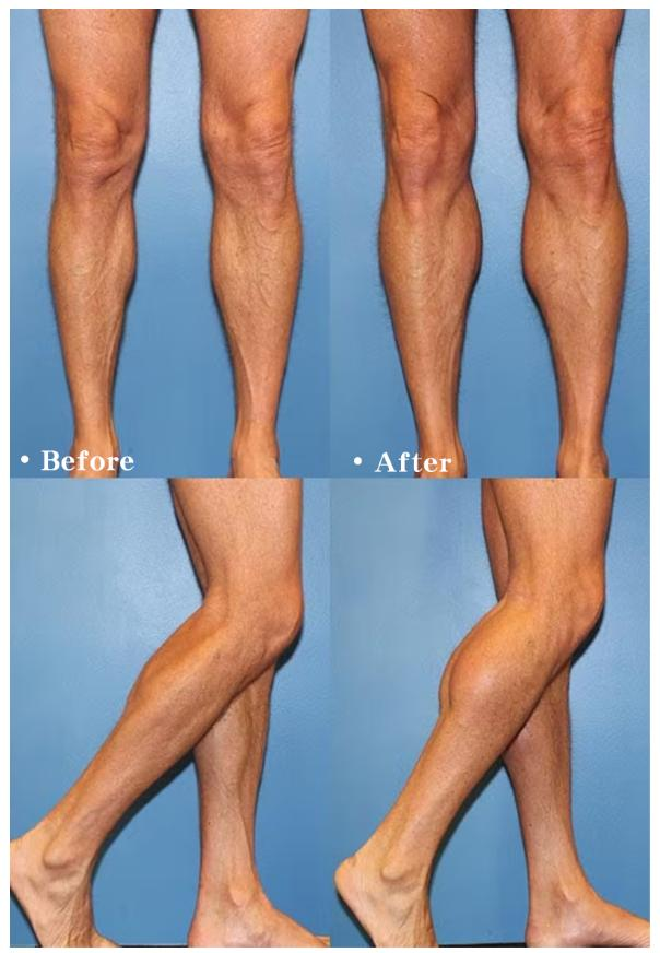 垫下巴假体费用