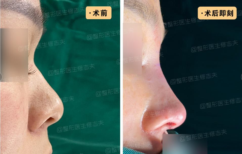 垫下巴假体费用