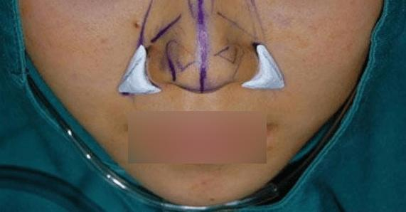 垫下巴假体费用