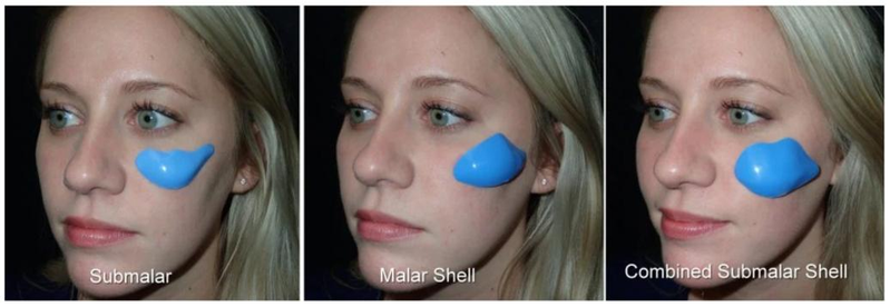 垫下巴假体费用