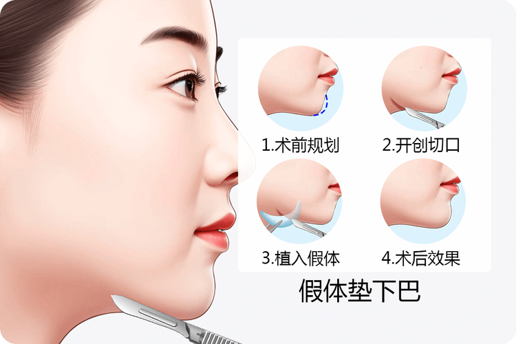 垫下巴假体费用