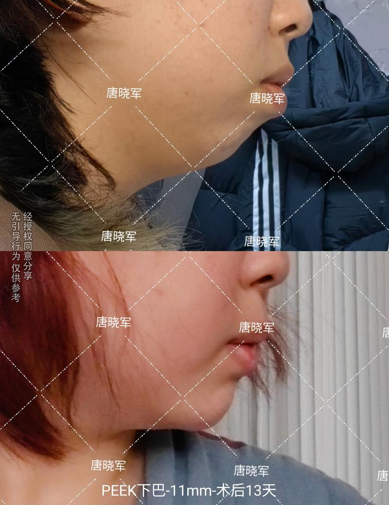 垫下巴假体费用