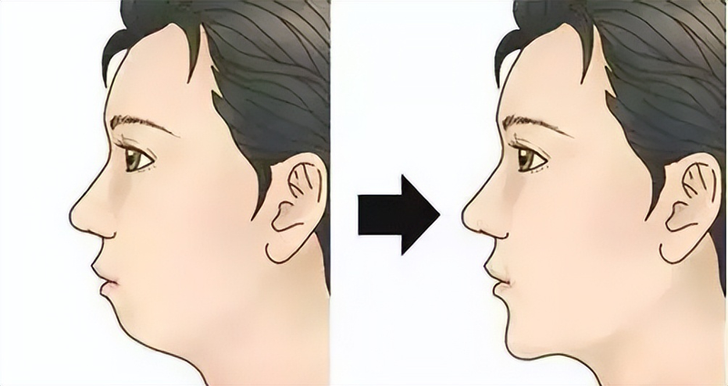 垫下巴假体费用