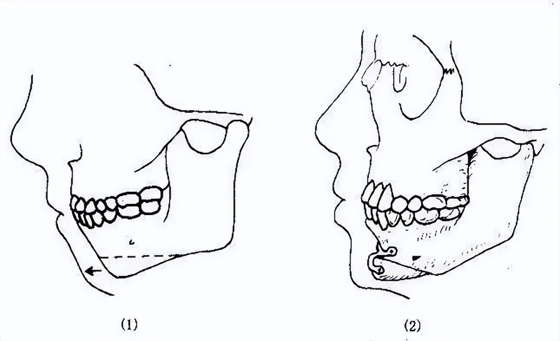 垫下巴假体费用