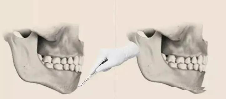 垫下巴假体费用