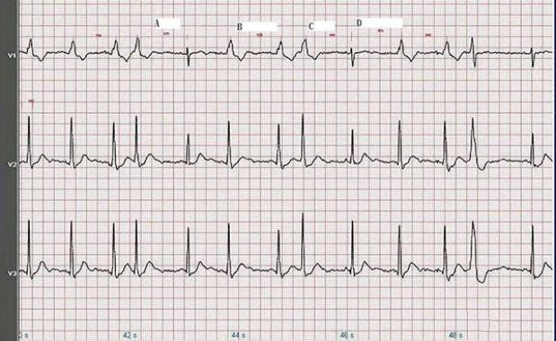 ecg心率的计算原理