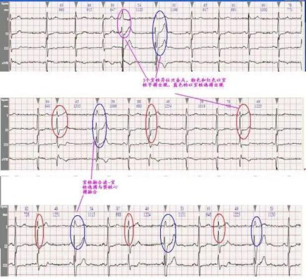 ecg心率的计算原理