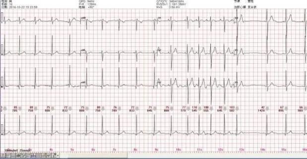 ecg心率的计算原理
