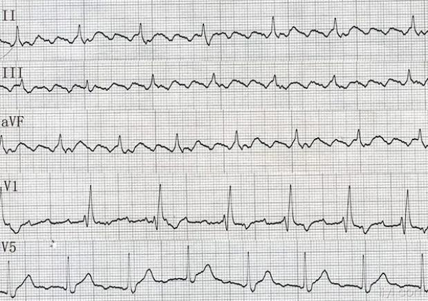 ecg心率的计算原理