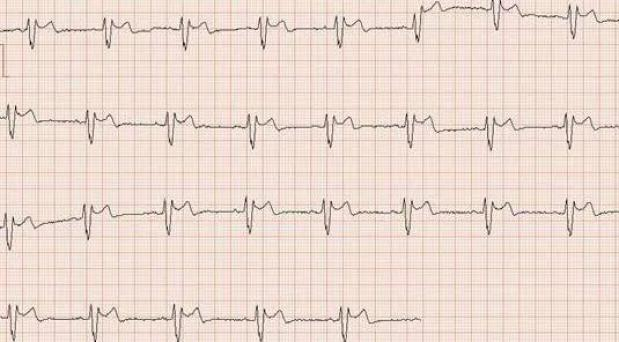 ecg心率的计算原理