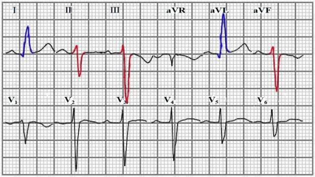 ecg心率的计算原理