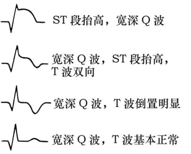 ecg心率的计算原理