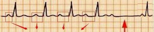 ecg心率的计算原理