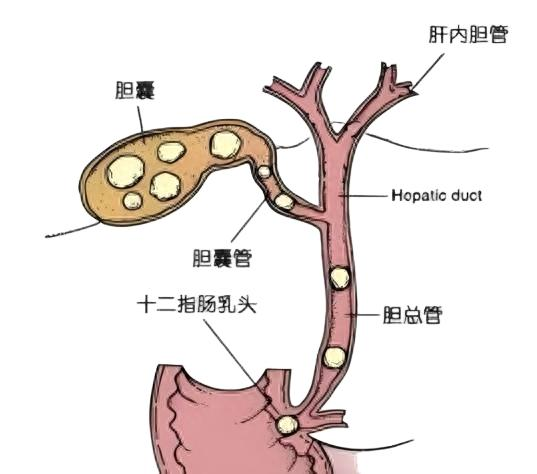 Excp stone recovery costs