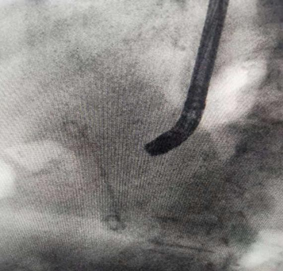 Excp stone recovery costs