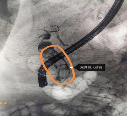 Excp stone recovery costs