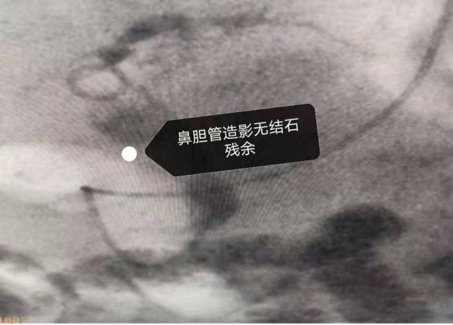 Excp stone recovery costs