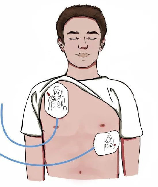 家庭触电急救方法