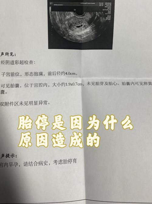 无痛人流经验