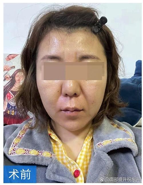 Beijing nose costs