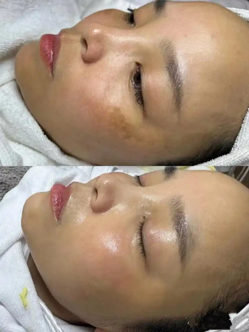 有什么祛斑的好方法