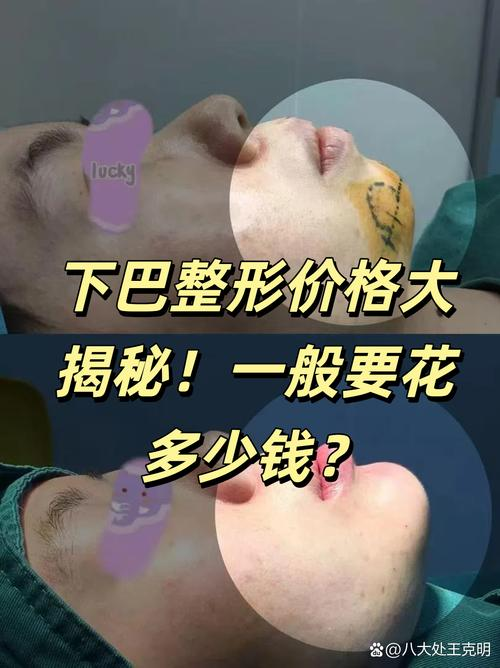 The price of self-empowerment chest surgery