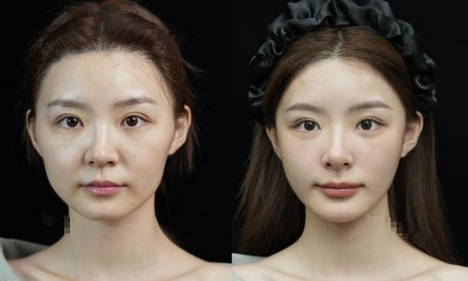 The price of self-empowerment chest surgery