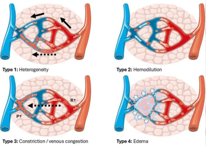 休克晚期微循环灌流特点分别是