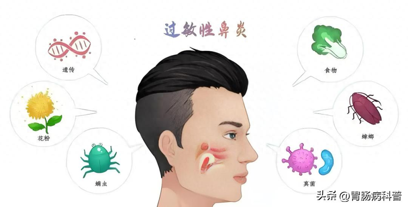 过敏性鼻炎特点