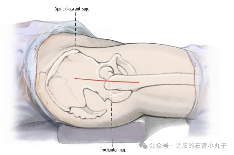 Bones replacement procedure