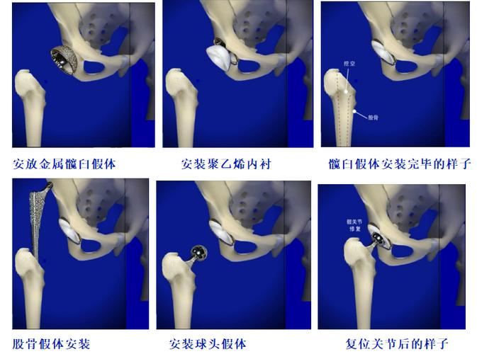 Bones replacement procedure