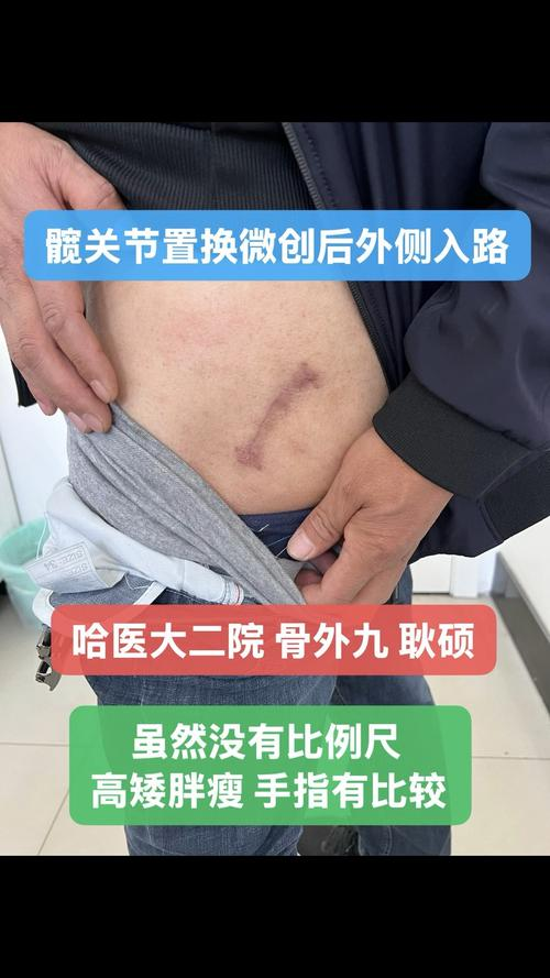 Bones replacement procedure