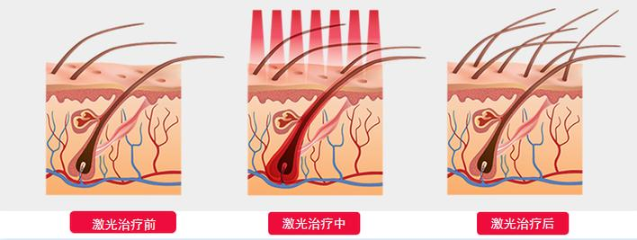 斑秃怎么治疗小偏方经验