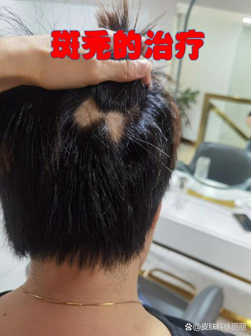 斑秃怎么治疗小偏方经验