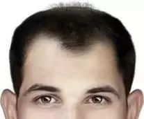 pdt毛发种植技术