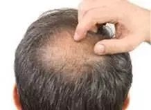 pdt毛发种植技术