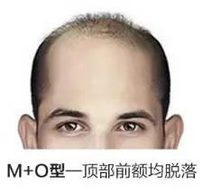 pdt毛发种植技术