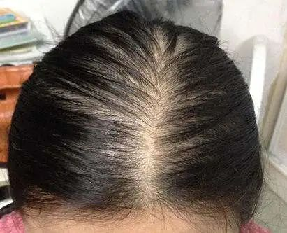 pdt毛发种植技术