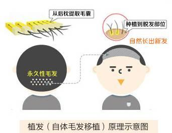 pdt毛发种植技术