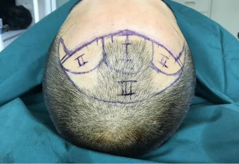 pdt毛发种植技术