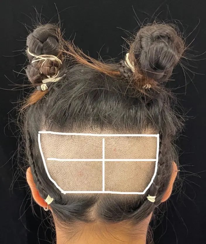 pdt毛发种植技术