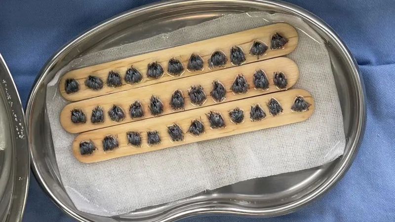 pdt毛发种植技术