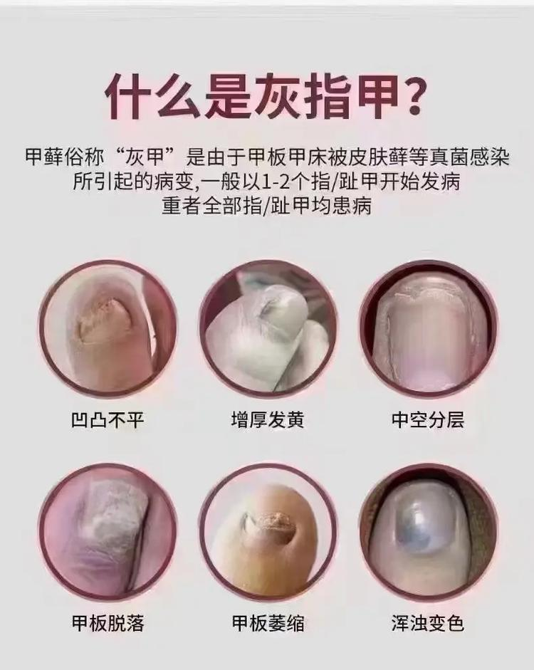 灰指甲的成因