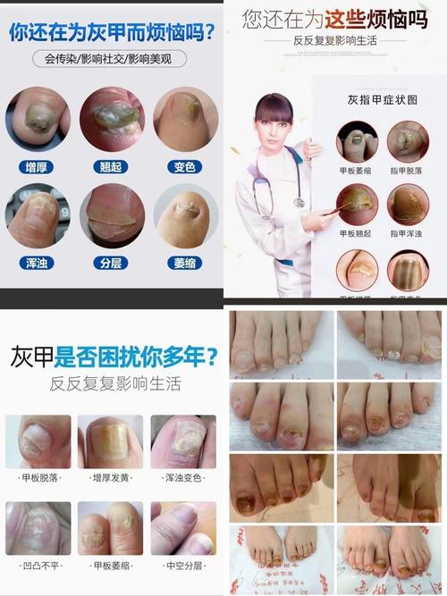 The cause of the gray nails