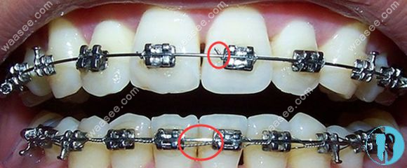 What's the method for the teeth